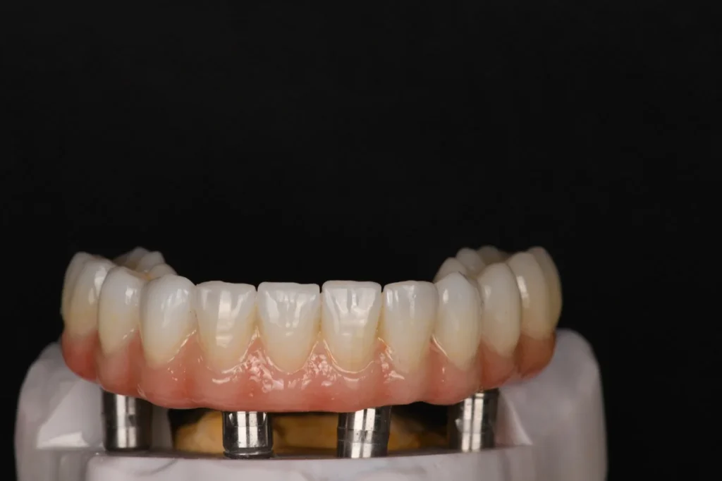 All-on-4-Zirconia-on-Ti-Bases-with-Porcelain-Build-Up-1