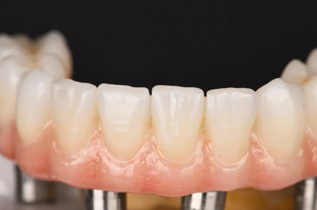 All-on-4-Zirconia-on-Ti-Bases-with-Porcelain-Build-Up-2