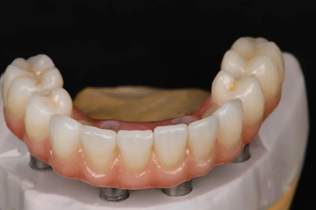 All-on-4-Zirconia-on-Ti-Bases-with-Porcelain-Build-Up-3