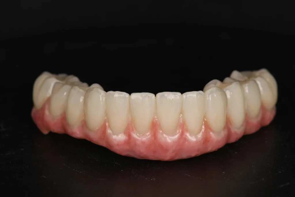 All-on-X-Zirconia-on-Ti-Bar-–-Lower-Arch-1