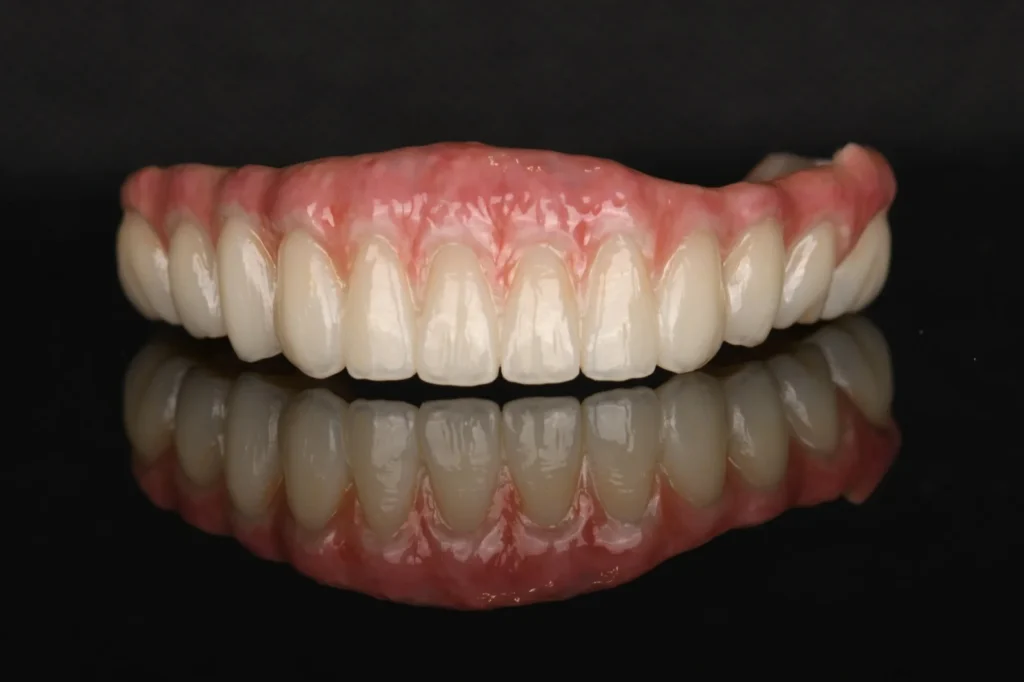 All-on-X-Zirconia-on-Ti-Bar-–-Lower-Arch-2