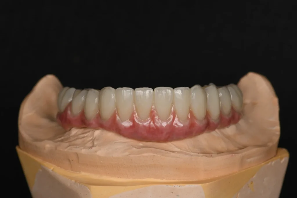 All-on-X-Zirconia-on-Ti-Bar-–-Lower-Arch-3
