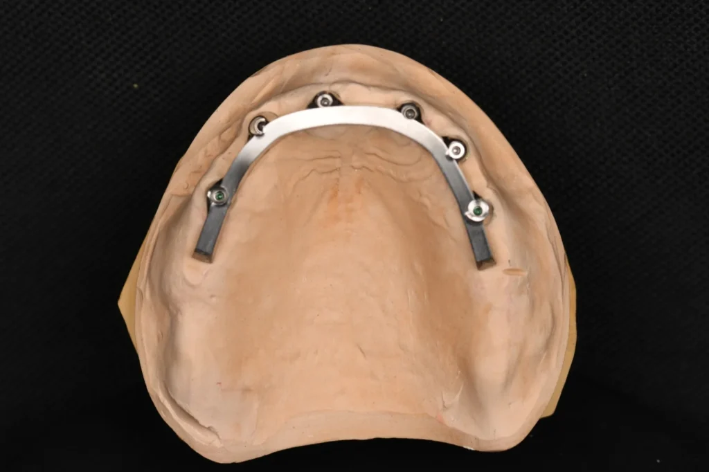All-on-X-Zirconia-on-Ti-Bar-–-Upper-Arch-2