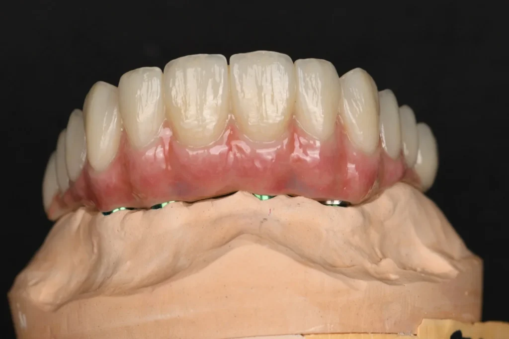 All-on-X-Zirconia-on-Ti-Bar-–-Upper-Arch-3