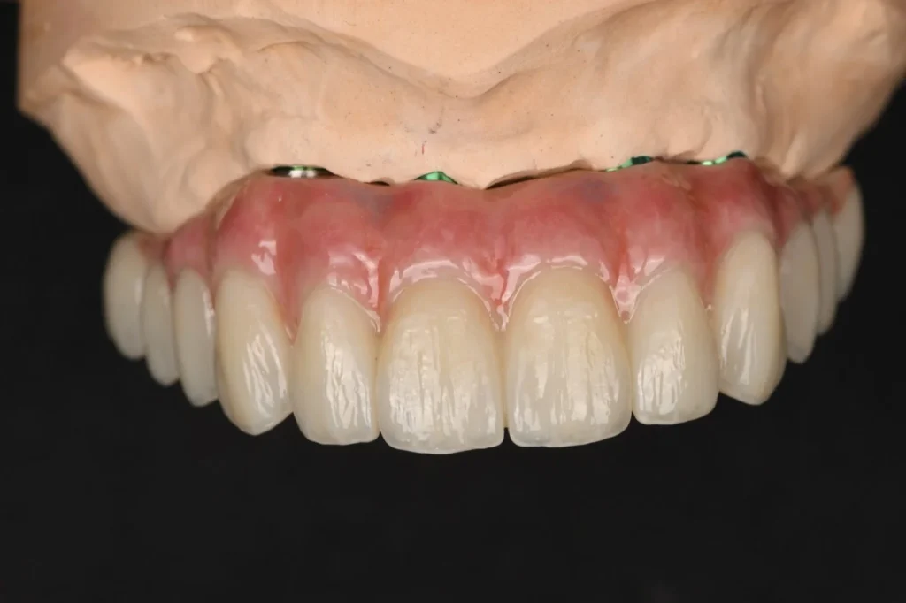 All-on-X-Zirconia-on-Ti-Bar-–-Upper-Arch-4
